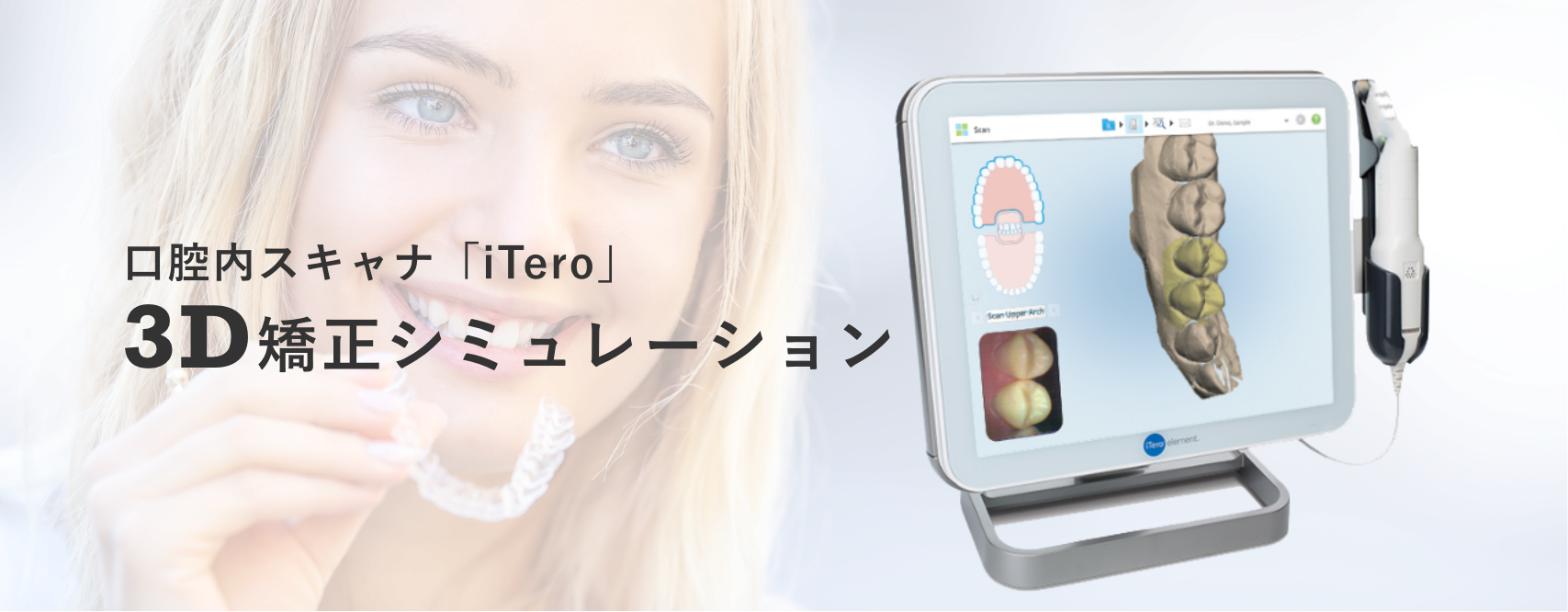 口腔内スキャナ「iTero」 3D矯正シミュレーション